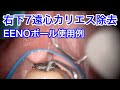 大臼歯遠心カリエス除去｜EENOボールチップとEENOスフィアチップの使用例｜右下7遠心カリエスの治療症例|EENOチップ【歯科医師向け】