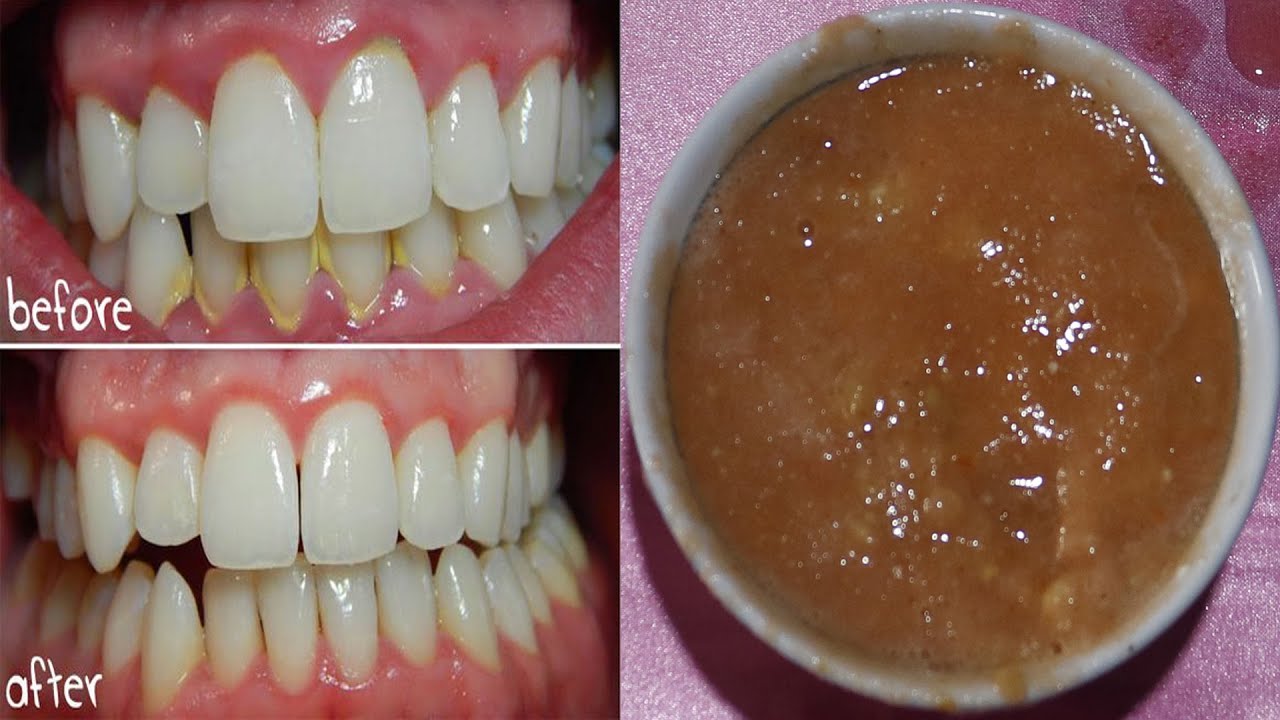 Only 4 natural ingredients will help whiten teeth at home. YouTube