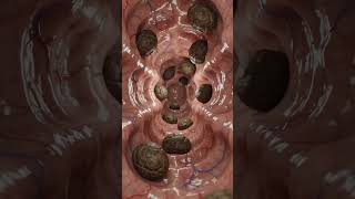 Severe Constipation Inside the Colon