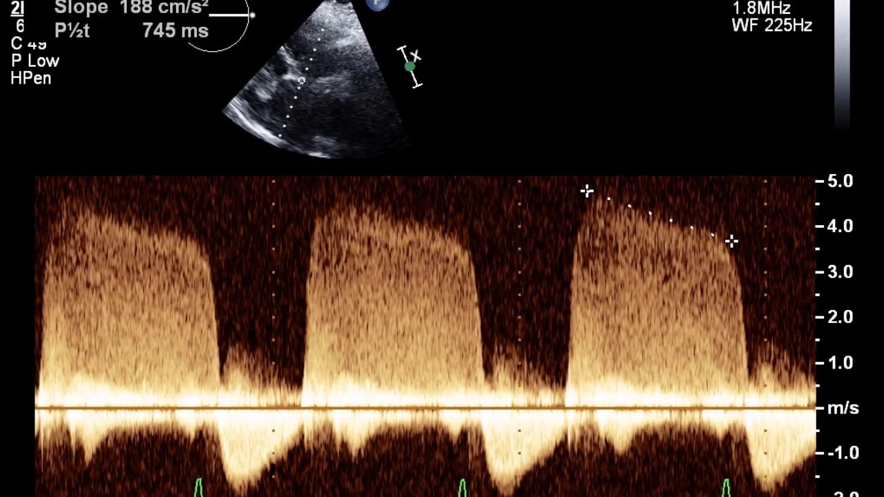 Echocardiogram With Mild Aortic Insufficiency YouTube
