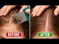 Head Lice Removal Before & After 😱 | Real Results in one Minutes