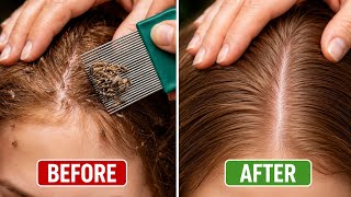 Head Lice Removal Before & After 😱 | Real Results in one Minutes