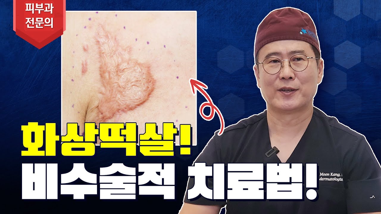 NO 수술🙅🏻‍♂️ 화상떡살 확실하게 치료하는 법 [feat. 화상흉터 명의피셜]