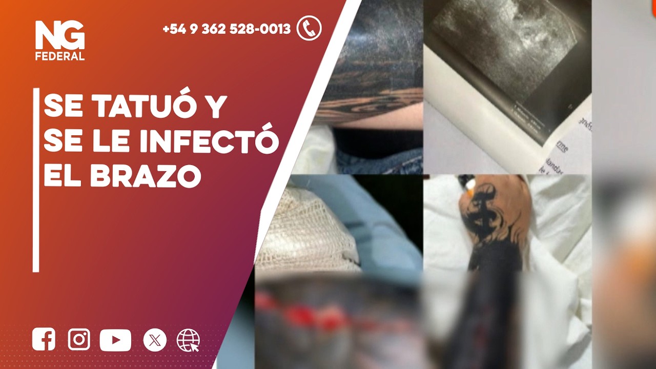 ►Un joven casi pierde el brazo tras una grave infección por un tatuaje