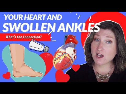 Swollen ankles &  your heart - Can leg swelling cause heart disease? GERI-Minute #176