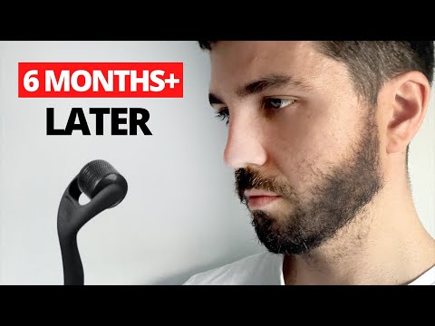 Beard Roller Before & After - 6 Month Update