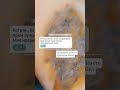 коррекция гиперкератоза( потливость подмышек,ладоней, стоп) инъекциями бта. 100ед на данную область.
