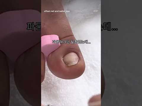 3배까지 키워드림#아크릴패디 #문제성발톱 #발톱복원
