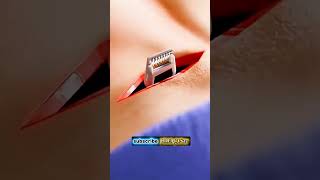 How this Tiny Device Blocks Back Pain Forever!🧠💉#BackPainRelief #FutureScience#MedicalTechnology