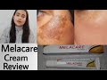 Melacare Cream Review |हिन्दी मैं | मेलाकेयर क्रीम उपयोग  फायदे और नुकसान