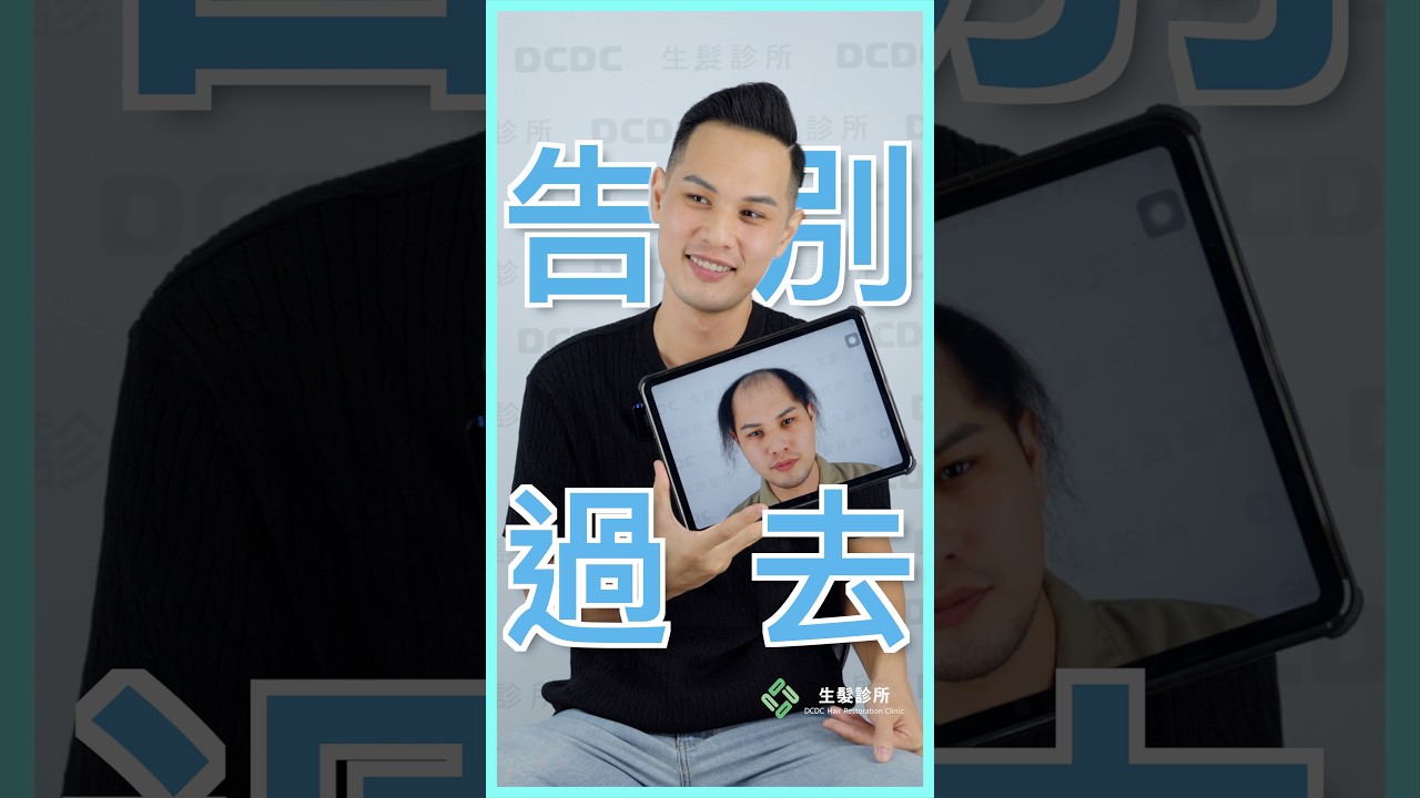 看到以前的自己,才知道植髮改變有多大!【DCDC植友分享】 縮圖