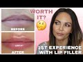 MY EXPERIENCE WITH LIP FILLER / INJECTIONS | 1ST 14 DAYS