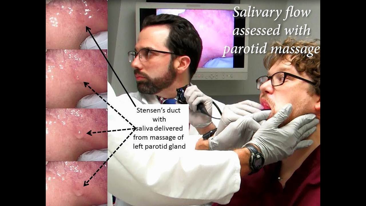 Salivary gland massage (parotid massage technique demonstrated) | Iowa Head  and Neck Protocols