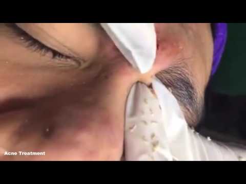 Cystic Acne, Pimples And Blackheads Extraction Treatment On Nose! Part 