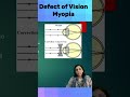 DEFECT OF VISION MYOPIA