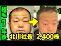 【植毛1年経過】令和の虎 北川社長のM字ハゲが大幅改善されました!!【自毛植毛|薄毛治療|髪の毛】