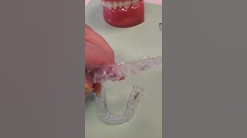How elastics are worn with Clear Aligners