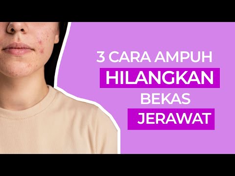 ampuh-!!-inilah-3-cara-menghilangkan-bekas-jerawat-dengan-bahan-alami
