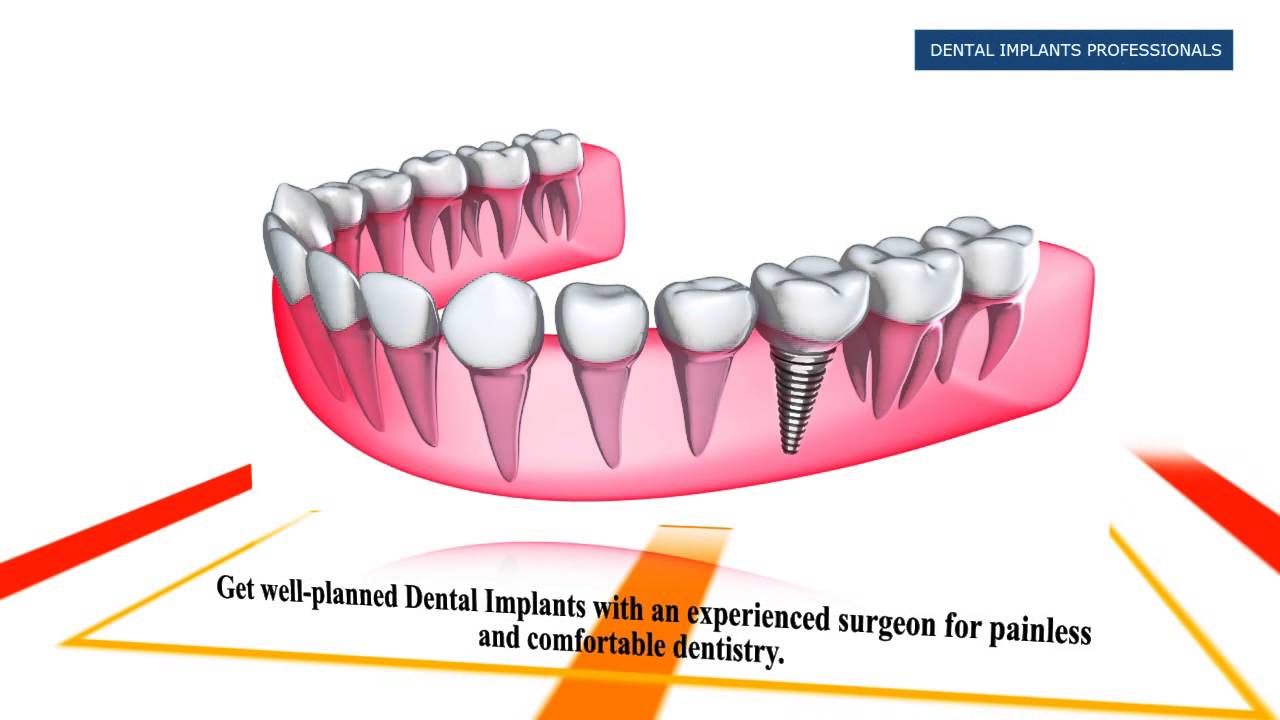 Cheap Dental Implants in Melbourne Dental Implants Professionals