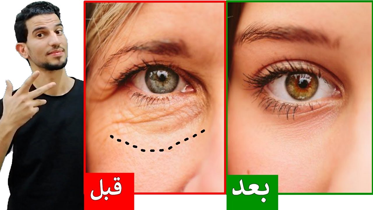 وصفه سحرية للتخلص من تجاعيد تحت العين وحول العين في اسرع وقت