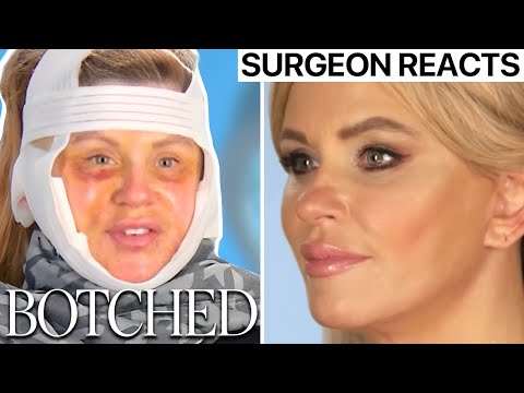 Surgeon Reacts to BOTCHED - Facelift Gone Wrong