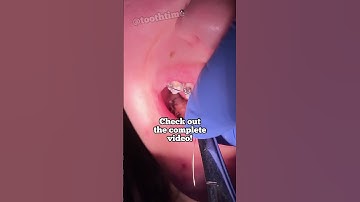 Braces On - What does a reverse curve wire do for braces? Tooth Time Family Dentistry New Braunfels