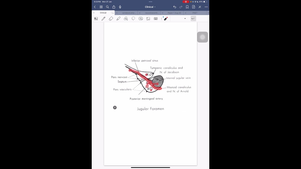 Jugular foramen syndromes