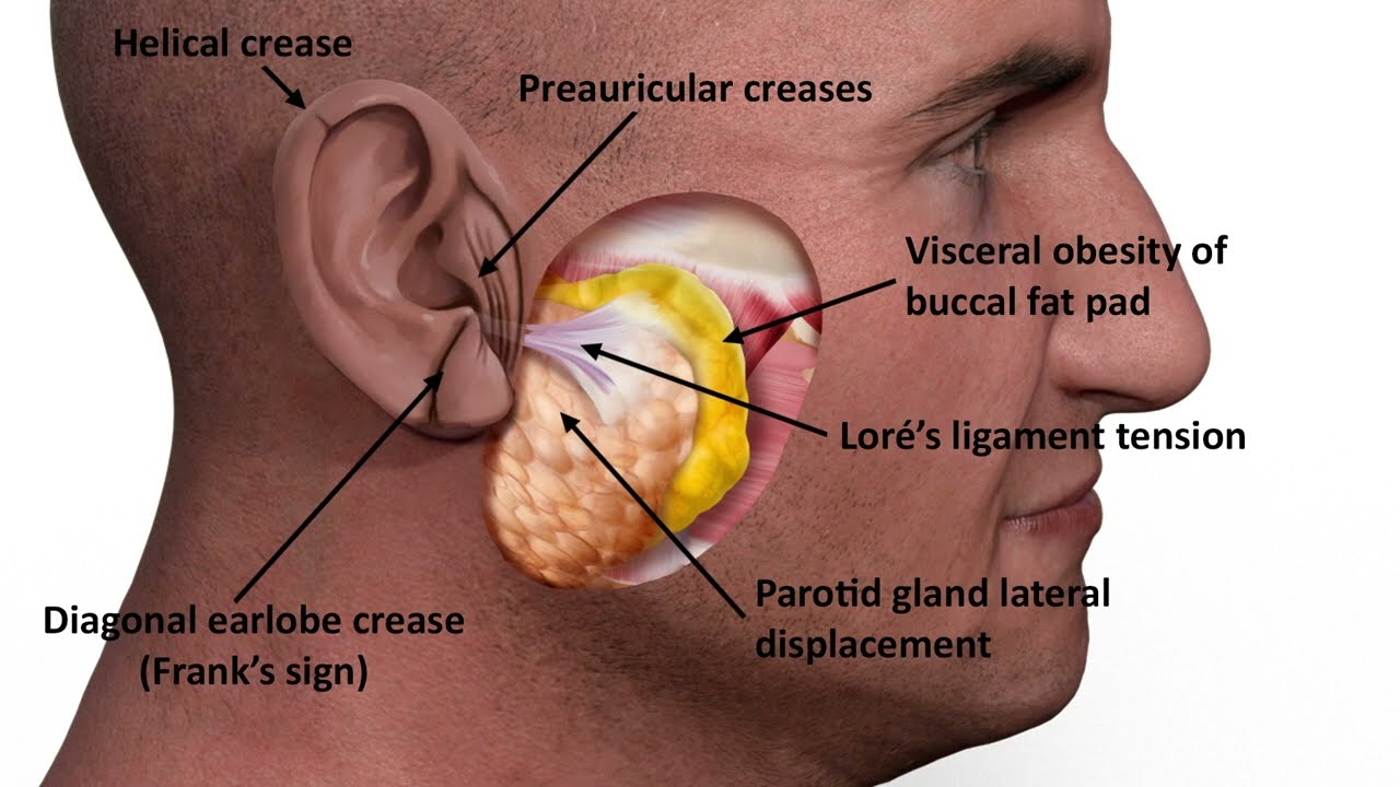 Video Abstract: Ear Creases