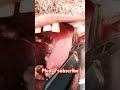 Maxillary third molar remove#dentistry 🦷💉