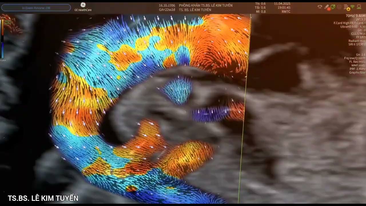 Pulmonary Atresia with VSD (PA-VSD type IV). TS.BS. LÊ KIM TUYẾN thực hiện trên máy siêu âm Voluson.