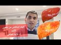 دهون الكبد وعلاجها وهل هى خطر وهل ممكن ان تؤدى لتليف الكبد 