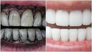 3 Way to Whiten Your Yellow Teeth Naturally