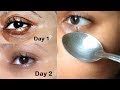 How to Remove Under Eye WRINKLES, Under Eye Bags, Puffy eyes & Dark Circles in 1 Day with ice cubes