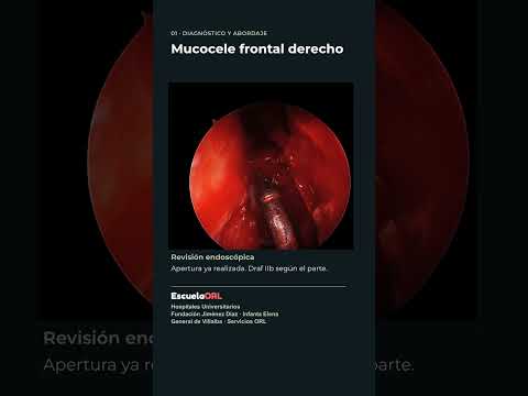 Miniatura: Mucocele frontal derecho: TC, RM y apertura endoscópica | EscuelaORL #Shorts