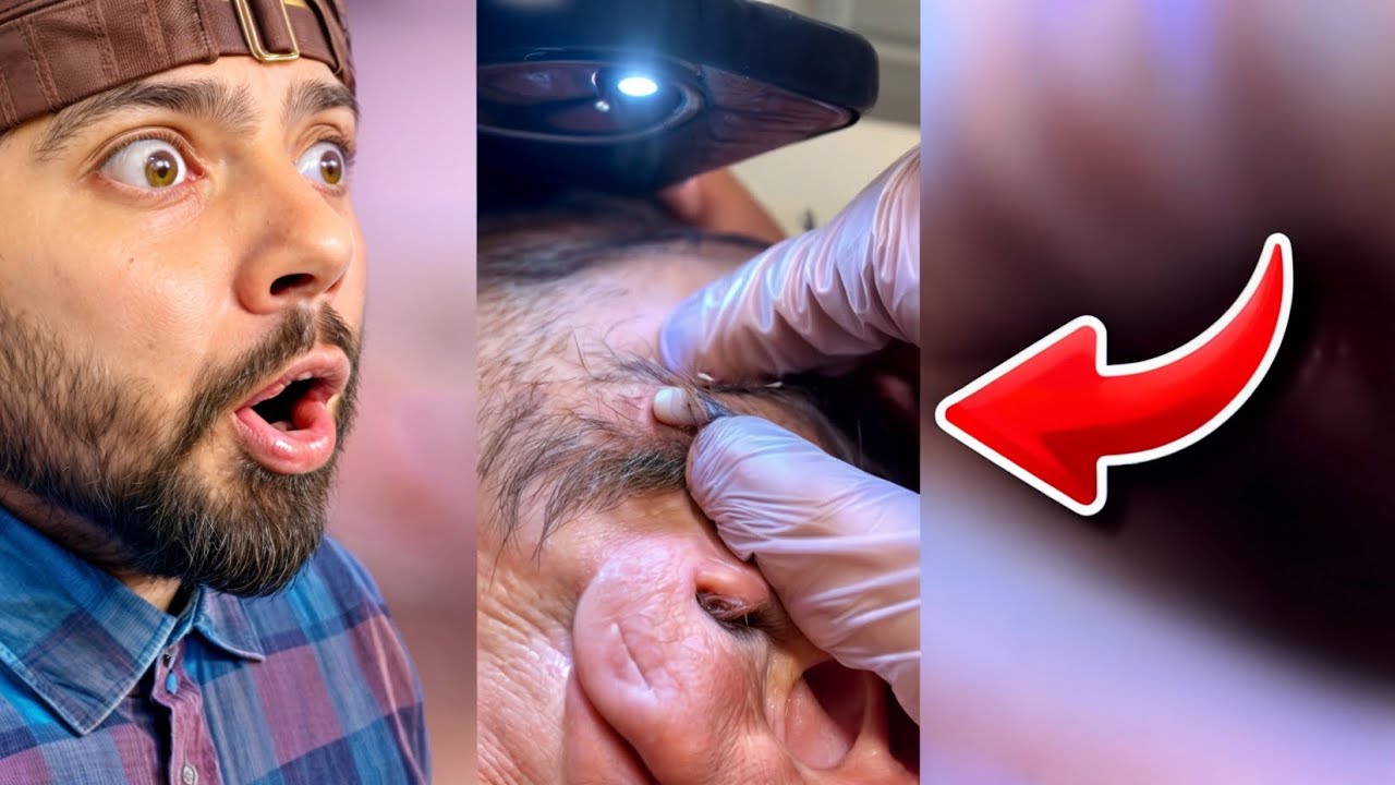 popping-huge-blackheads-and-giant-pimples-best-pimple-popping-videos