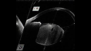 ASOCT in cataract surgery - Supplementary video 3 [ID 286996]