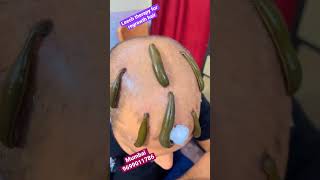 गंजेपन का रामबाण इलाज हैं Leech Therapy - #leechtherapy#kzhijama#leech#hair#hairfall#haircare#shorts screenshot 4