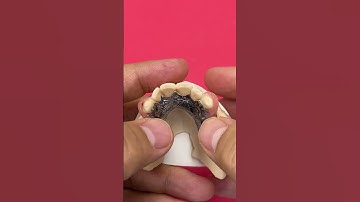 Pink Clasps on a Titanium Partial!