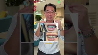 Why rubber bands for braces are so important! 😬 #orthodontist #braces #orthotips