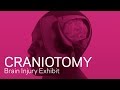 Craniotomy - Traumatic Brain Injury Animation