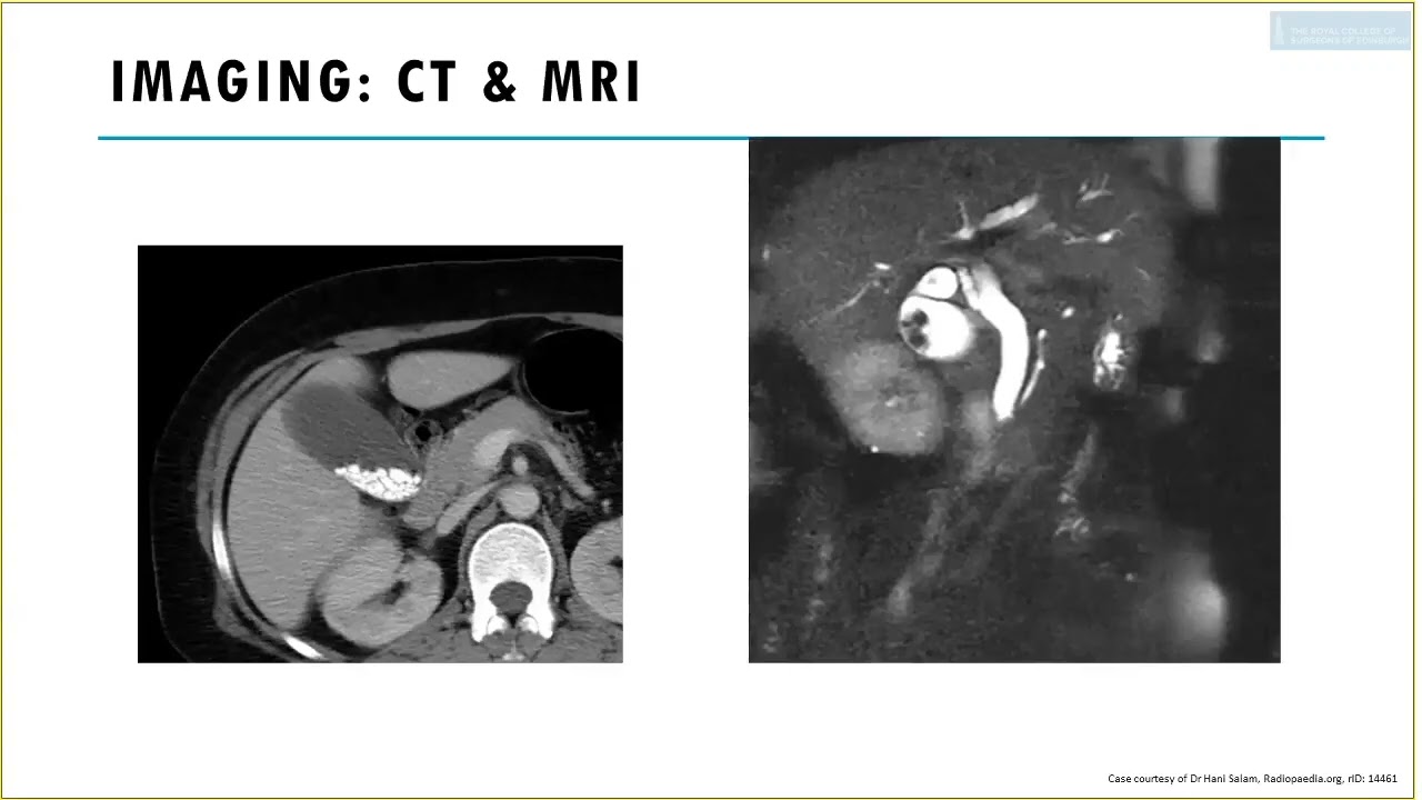 3  RCS Management of Gall Stone Disease