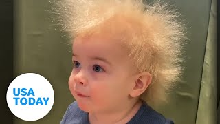 Uncombable hair syndrome: Baby's ultra-rare follicle genes