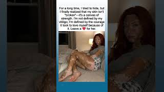 This Woman Turned Her Vitiligo Into a Symbol of Strength ❤️ #viralstory This Woman Turned Her Vitiligo Into a Symbol of Strength ❤️ #viralstory