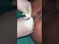 Rare Case of Fistula 👌 Treated without surgery #iillss #drsatya #ksharsutra #fistulainano #fissure