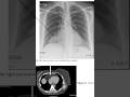 Pericardial fat associated with Afib, coronary artery disease, diabetes, CHF