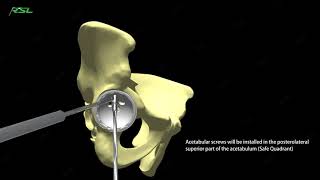 RSL Revision Stem Cementless