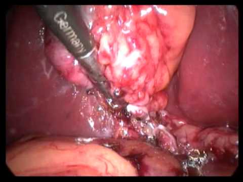 Lap  Cholecystectomy Unedited 248 Much Fat Covered GB In Severe Kypho Skoliotic Patient