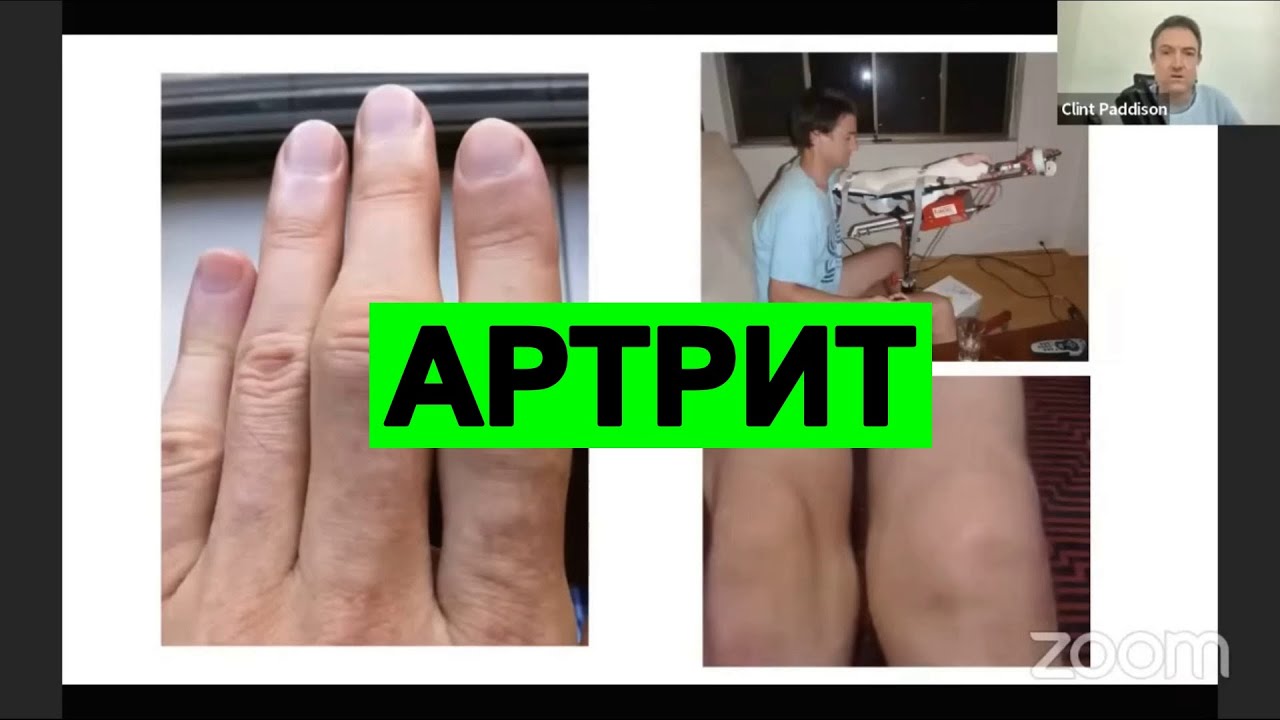 Лучший Метод Лечения Артрита | Клинт Пэддисон