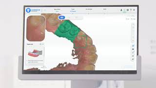 Aoralscan 3 - Scan Procedure