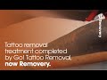 Tattoo Removal Laser Not Working